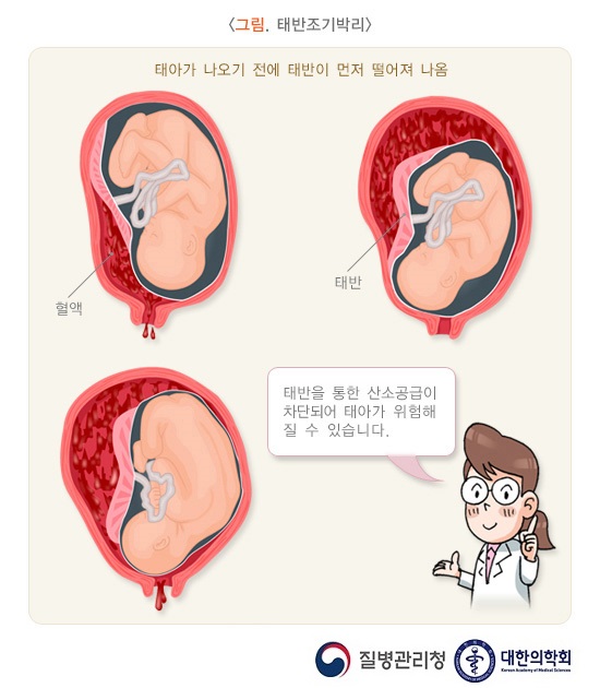 태아알코올증후군